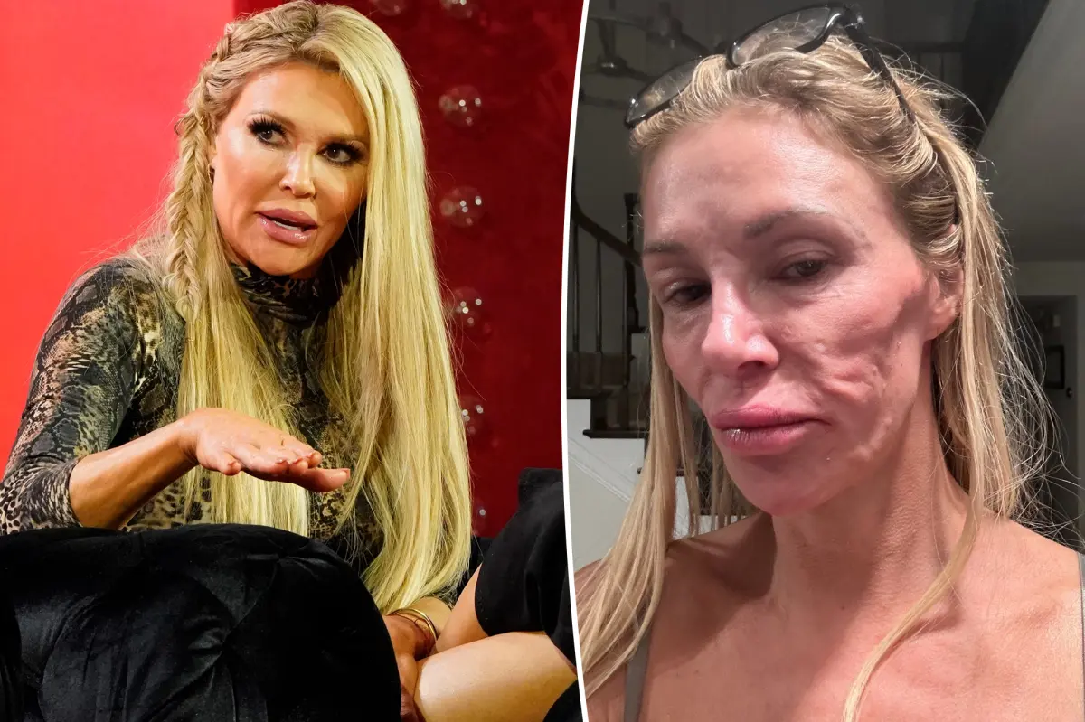 Brandi Glanville shares exorbitant cost of trying to figure out facial parasite mystery